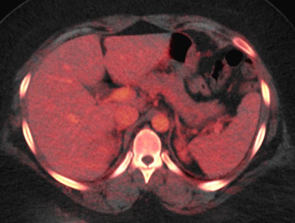 Research: Dual-energy CT in patients with abdominal malignant lymphoma