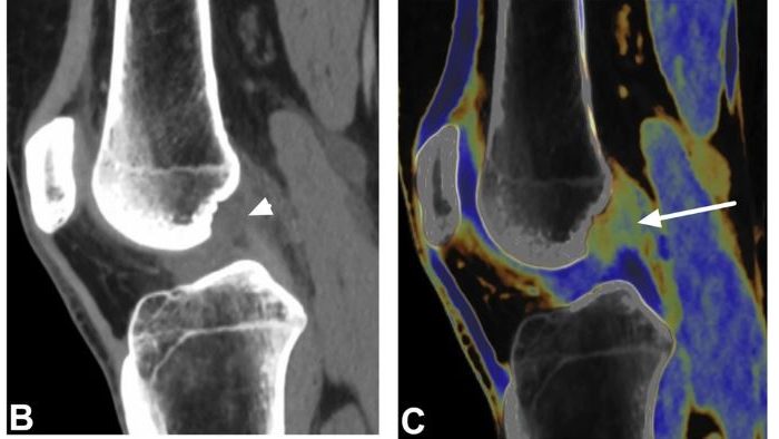 Dual-energy CT-based collagen maps improve diagnostic accuracy for cruciate ligaments assessment