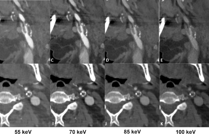 Publication “Carotid artery assessment in dual-source photon-counting CT: impact of low-energy virtual monoenergetic imaging on image quality, vascular contrast and diagnostic assessability” in La Radiologia Medica