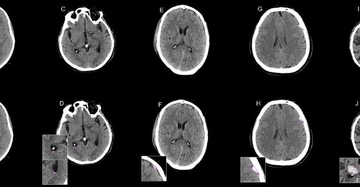 Publication on deep learning-based intracranial hemorrhage assessment in non-contrast CT scans