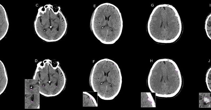 AI assistance improves radiology resident reader performance in CT diagnosis of intracranial hemorrhage
